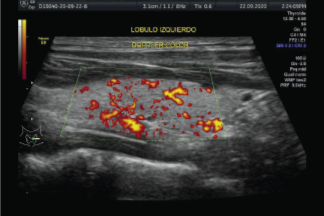 Biopsia de tiroides (BAAF)
